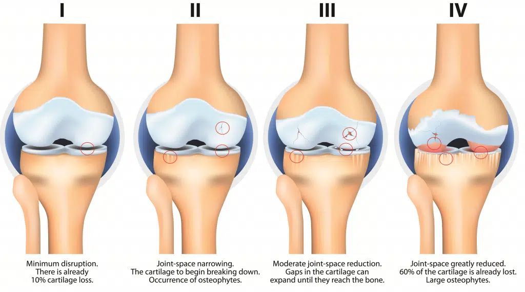 knee arthritis diagram